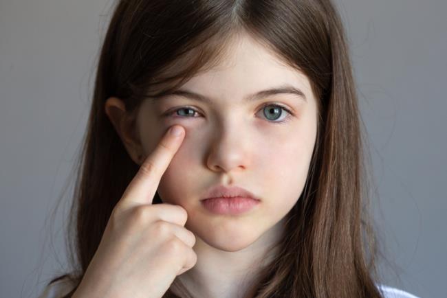 ילדה קטנה סובלת מדלקת עיניים אלרגית